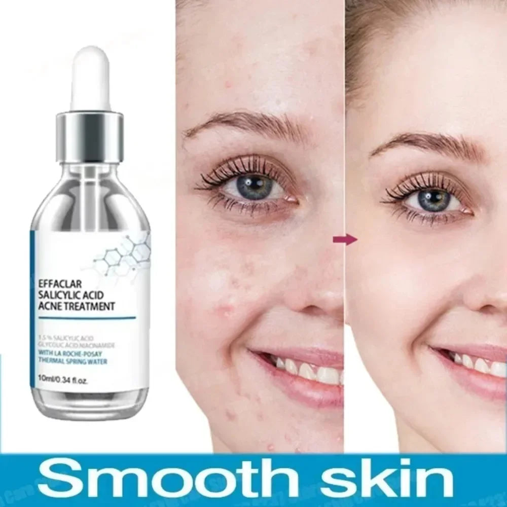 Fruit Acid Acne Face Serum